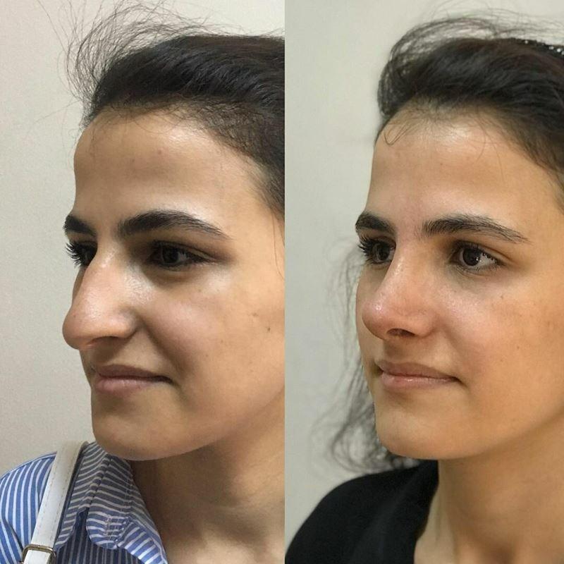 Подпилили клювики: фото, доказывающие, что пластика творит чудеса
