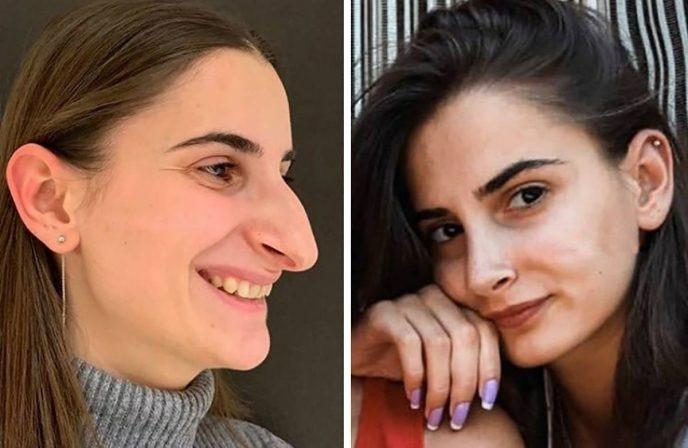 Подпилили клювики: фото, доказывающие, что пластика творит чудеса